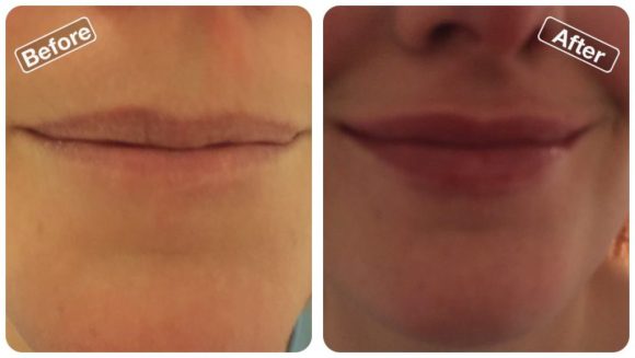 before and after lip fillers at Be Beautiful Salon in Preston