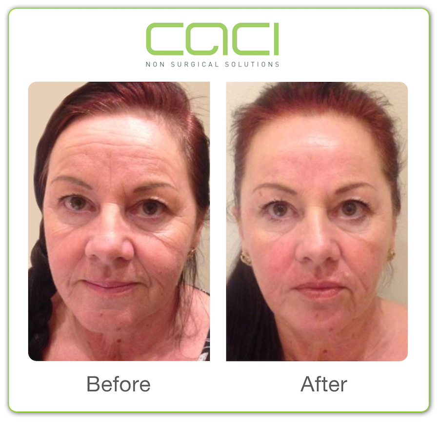 CACI face treatments at best beauty salon in Preston