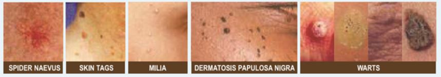 Skin Tag Removal Wart Removal Treatments in Preston