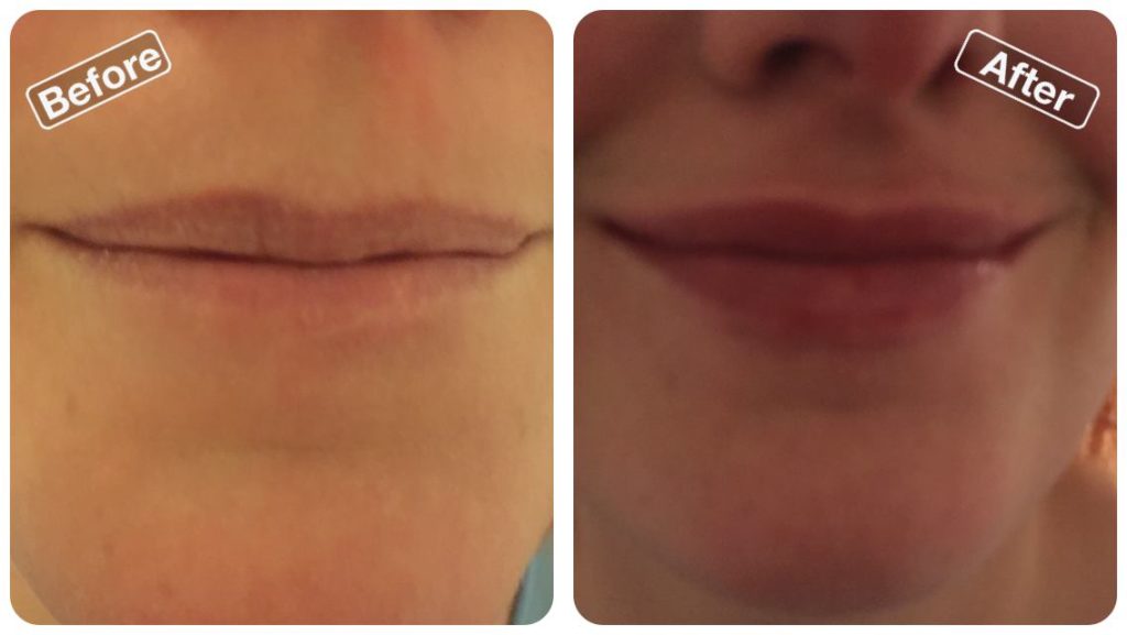 before and after lip fillers at Be Beautiful Salon in Preston