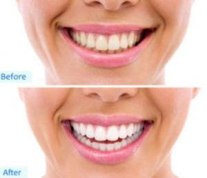 before after teeth whitening at Be Beautiful Beauty Salon in preston