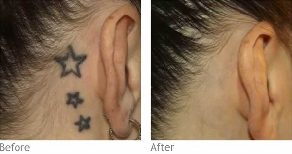 laser tattoo removal at be beautiful salon in preston