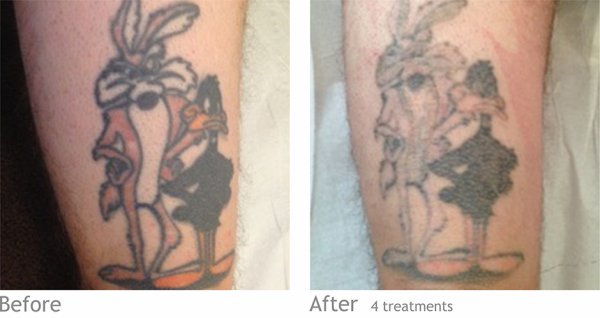tattoo removal experts in fulwood preston