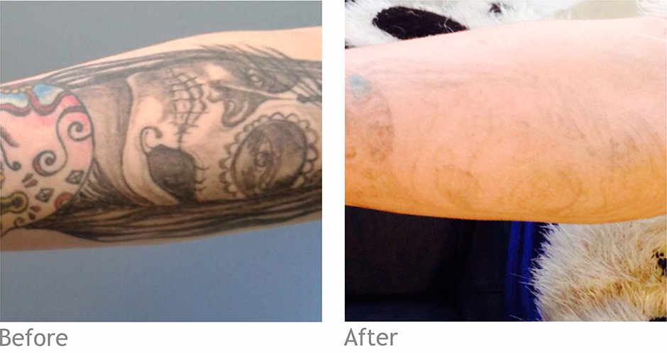 The Tattoo Removal Experts in Chiswick
