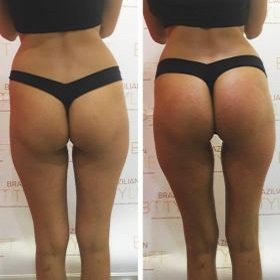 before and after butt lift at be beautiful salon in preston