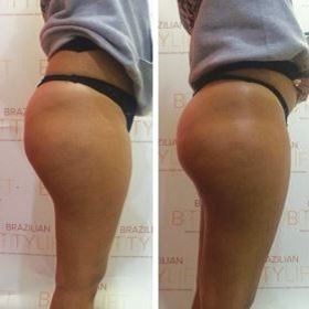 butt lift results at be beautiful beauty salon in fulwood preston