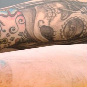TATTOO REMOVAL at BE BEAUTIFUL AESTHETIC CLINIC PRESTON