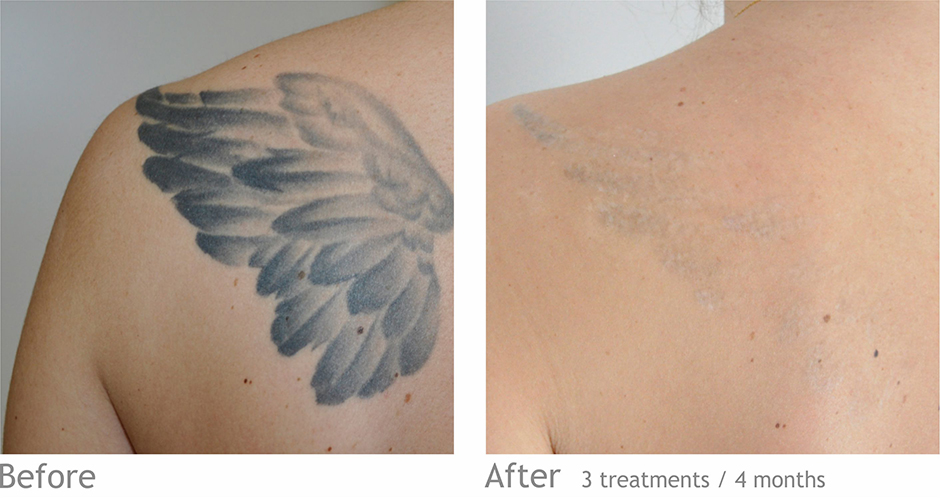 before big tattoo removal in Preston