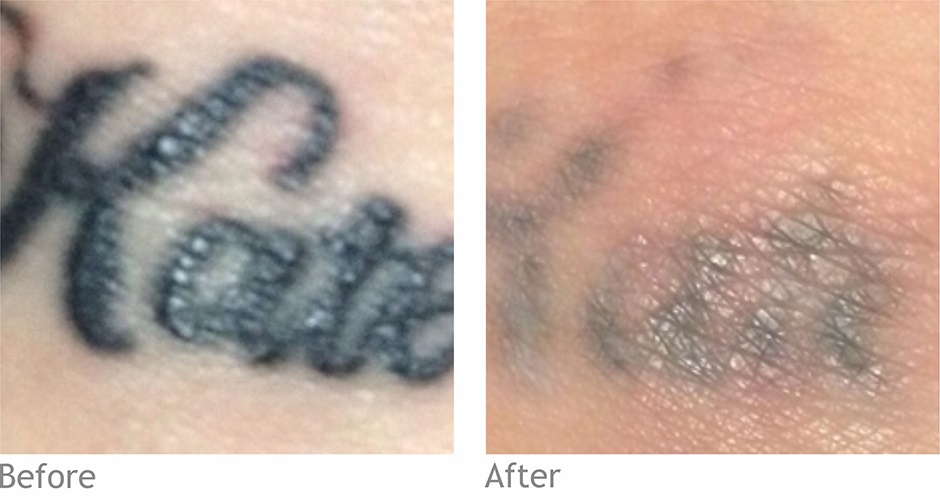 before tattoo removal in preston
