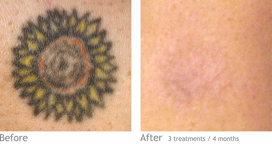 sun tattoo removal at be beautiful salon in preston