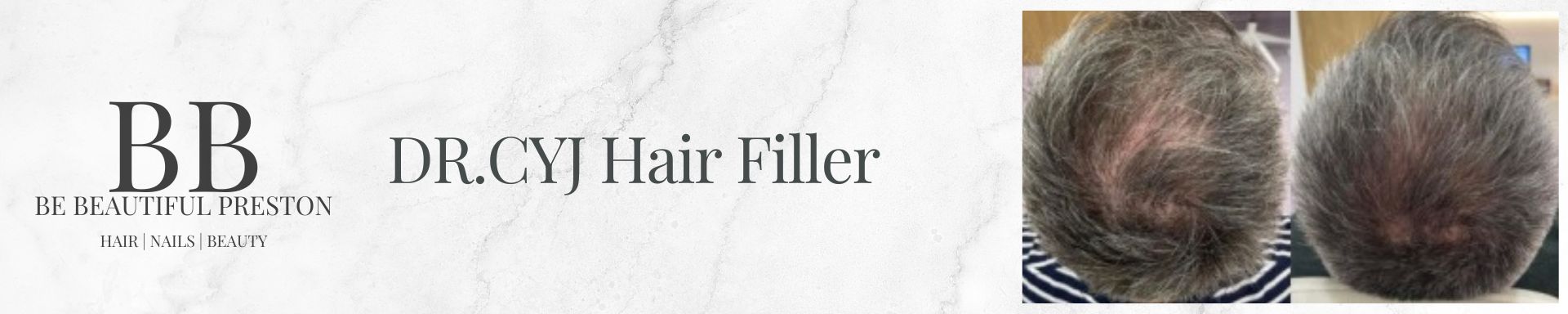 PROFESSIONAL HAIR LOSS TREATMENT IN PRESTON PROFESSIONAL HAIR LOSS TREATMENT IN PRESTON