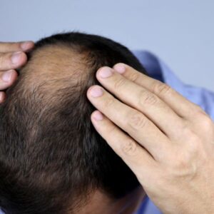 Male hair loss at Be Beautiful Hair and Beauty Preston Male hair loss at Be Beautiful Hair and Beauty Preston