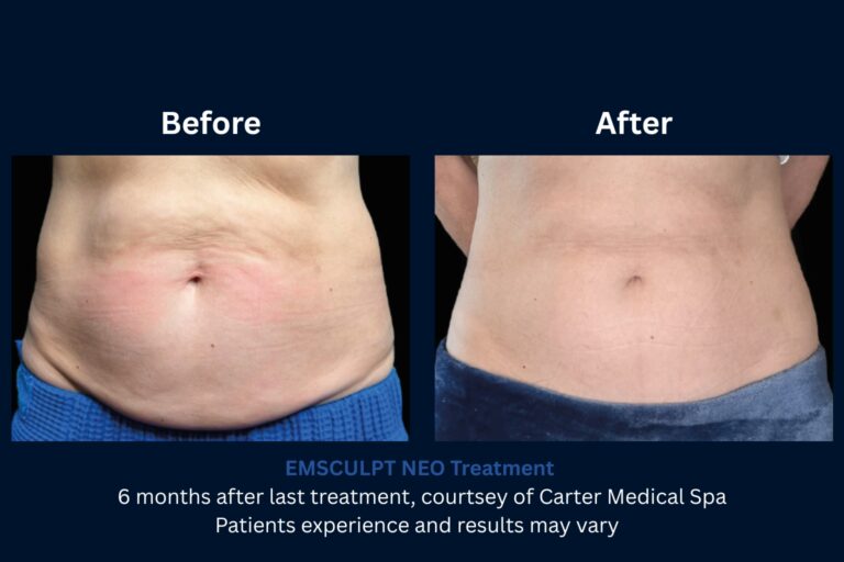 EMSCULPT NEO help with weight loss EMSCULPT NEO help with weight loss