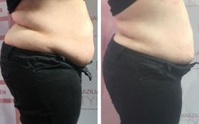 Fat-Reduction-Treatments-In-Preston-at-Be-Beautiful-Salon-Fulwood