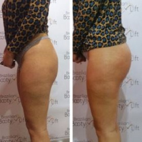 bottom-lift-results-at-be-beautiful-salon-in-preston